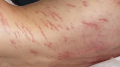 ചര്‍മ്മത്തിന് അകത്ത് പുഴുവരിക്കുന്നു; അപൂര്‍വ രോഗാവസ്ഥയുമായി ഒരാള്‍...