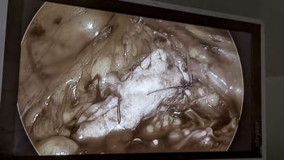 മൂത്രനാളിയിൽപ്രശ്നം, ആശുപത്രിയിലെത്തി, വായ്ക്കുള്ളിലെ തൊലി ഉപയോഗിച്ച് കൃത്രിമ മൂത്രനാളി സൃഷ്ടിച്ച് ശസ്ത്രക്രിയ