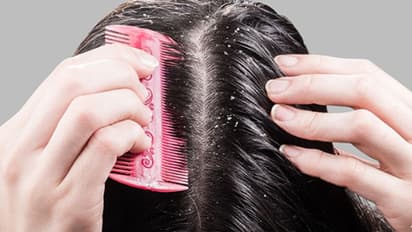 താരനകറ്റാൻ ഇതാ നാല് എളുപ്പ വഴികൾ