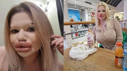 യഥാർത്ഥ പ്രണയത്തിന് വേണ്ടി കാത്തിരിക്കുകയാണ്; ലോകത്തിലെ ഏറ്റവും വലിയ ചുണ്ടുള്ള യുവതി പറയുന്നു 