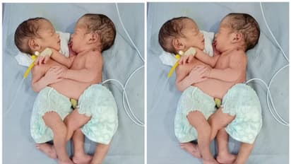 ശരീരം രണ്ട് പക്ഷേ വയര് ഒന്ന്; ഇന്ത്യയില് അപൂര്വ്വ ഇരട്ടകള് ജനിച്ചു, കുട്ടികള് ആരോഗ്യത്തോടെ ഇരിക്കുന്നു