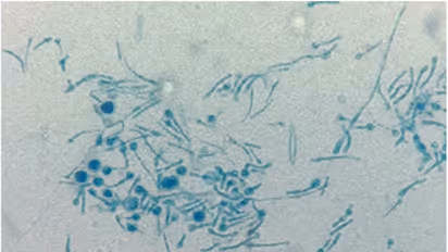 முதல் முறையாக மனிதருக்குப் பரவிய தாவரப் பூஞ்சை நோய்! மருத்துவர்கள் அதிர்ச்சி!