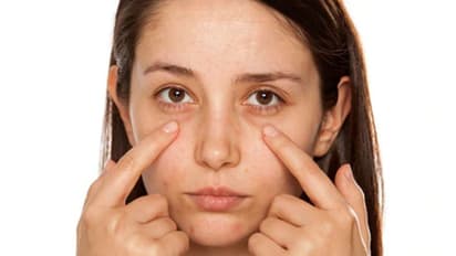 കണ്ണിന് ചുറ്റുമുള്ള കറുപ്പ് മാറാൻ ഇതാ മൂന്ന് പൊടിക്കെെകൾ