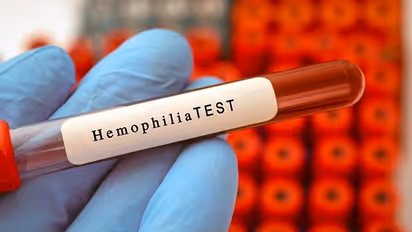 What is Hemophilia? Know about the genetic disorder, complications and to manage common co-occurring condition