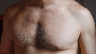 Gynecomastia: ಕೆಲವು ಪುರುಷರ ಸ್ತನಗಳ ಗಾತ್ರ ಹೆಚ್ಚಾಗಿರಲು ಕಾರಣ ಏನು? ಪರಿಹಾರ ಹೇಗೆ?