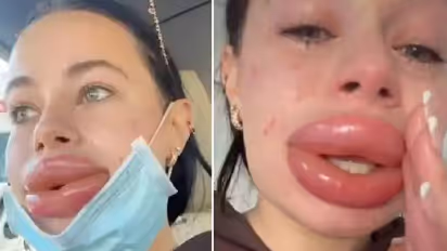 ഭം​ഗി വർധിപ്പിക്കാൻ സൗജന്യ കോസ്മെറ്റിക് ചികിത്സ, ചുണ്ടുകൾ വീർത്തുവന്നു, ദുരനുഭവം വെളിപ്പെടുത്തി യുവതി