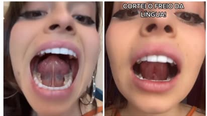 'നന്നായി ചുംബിക്കണം'; നാക്കിന് താഴത്തെ ടിഷ്യു നീക്കം ചെയ്ത് യുവതി 