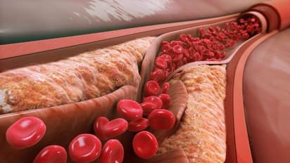  ഉയർന്ന കൊളസ്ട്രോൾ കുറയ്ക്കാൻ ഇതാ ചില വഴികൾ 