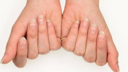 വരണ്ട ചര്മ്മം, കേടായ പല്ലുകളും നഖങ്ങളും; തിരിച്ചറിയാം ഈ ആരോഗ്യപ്രശ്നം...