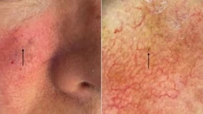 ഈ ചെറിയ ചുവന്ന കുത്ത് സ്കിൻ കാൻസറിന്റെതെന്ന് ഡോക്ടർമാർ കണ്ടെത്തി, ഒടുവിൽ ഗിന്നസ് ബുക്കില് ഇടംപിടിച്ചു