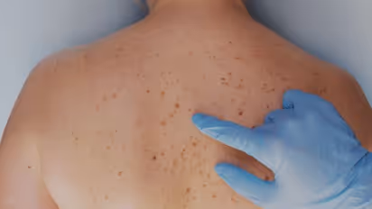 മറുകുകള്‍ വലുതാകുന്നതും നിറം മാറുന്നതും പുതുതായി ഉണ്ടാകുന്നതുമെല്ലാം ശ്രദ്ധിക്കുക....