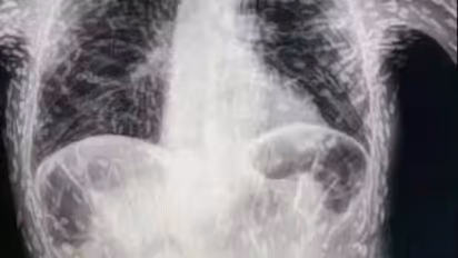 பல ஆண்டுகளாக தொடர் இருமலால் அவதிப்பட்டு வந்த நபர்.. X-Ray ஸ்கேனை பாரத்து அதிர்ந்து போன மருத்துவர்கள்..