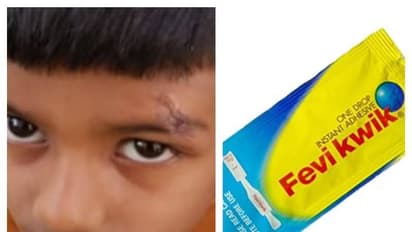 சிறுவனின் காயத்திற்கு ஃபெவிகுவிக் போட்டு சிகிச்சை அளித்த மருத்துவர்.. அதிர்ந்து போன பெற்றோர்..