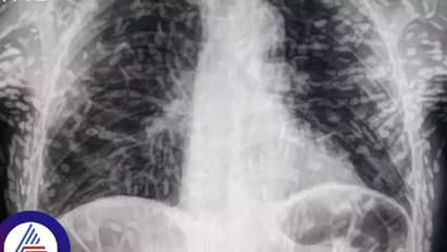 ವಿಪರೀತ ಕೆಮ್ಮೆಂದು ಆಸ್ಪತ್ರೆಗೆ ಹೋದ ವ್ಯಕ್ತಿ, ಸ್ಕ್ಯಾನ್ ಮಾಡಿದಾಗ ದೇಹ ಪೂರ್ತಿ ಹುಳುಗಳು!