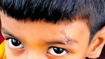 ಗಾಯಕ್ಕೆ ಹೊಲಿಗೆ ಹಾಕುವ ಬದಲು ಫೆವಿಕ್ವಿಕ್ ಹಾಕಿದ ತೆಲಂಗಾಣದ ವೈದ್ಯ!