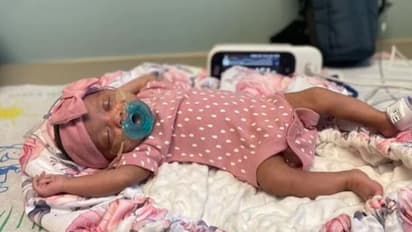 ജനിക്കുന്നതിന് മുമ്പ് കുഞ്ഞിന് മസ്തിഷ്കത്തിൽ ശസ്ത്രക്രിയ; കാരണം അപൂർവ അവസ്ഥ, വിജയം!