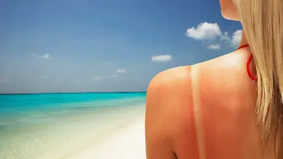 Here are 7 magical home remedies to beat the sunburn this summer season