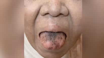 ആന്റിബയോട്ടിക്സ് കഴിച്ചതിന്റെ ഭാഗമായി നാവിന് സംഭവിച്ചത്; സ്ത്രീയുടെ അനുഭവം ശ്രദ്ധിക്കപ്പെടുന്നു