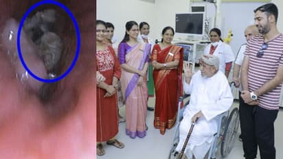 4 വർഷമായി ചുമ, കഴുത്ത് അനക്കാൻ പറ്റാത്ത വേദന, ഒമാൻ സ്വദേശിക്ക് കേരളത്തിൽ ചികിത്സ, നീക്കം ചെയ്തത് എല്ലിൻ കഷണം 