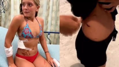 തന്നെ കടിച്ച സ്രാവിനെ ഇടിച്ചോടിച്ചു; തലനാരിഴയ്ക്ക് രക്ഷപ്പെട്ട് 13കാരി; വീഡിയോ