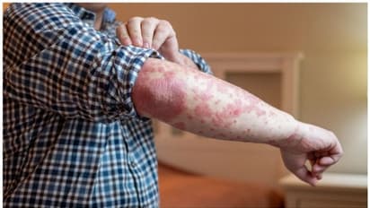 സോറിയാസിസ് രോഗം നേരത്തെ തിരിച്ചറിയാം ; ശ്രദ്ധിക്കേണ്ടത്...