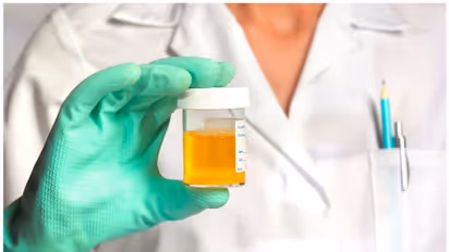 മൂത്രത്തിന് കടും മഞ്ഞ നിറമാണോ? ഇക്കാര്യങ്ങൾ അറി‍ഞ്ഞിരിക്കൂ 