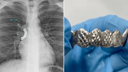 കടുത്ത ചുമയും ശ്വാസംമുട്ടലും; 22കാരന്റെ ശ്വാസകോശത്തിൽ കുടുങ്ങിയത്...