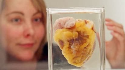 16 വർഷങ്ങൾക്ക് ശേഷമുള്ള കൂടിക്കാഴ്ച; സ്വന്തം 'ഹൃദയം' കാണാൻ മ്യൂസിയം സന്ദർശിച്ച് യുവതി