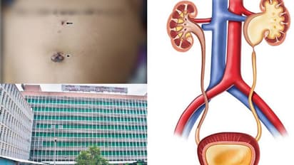 മൂന്ന് മാസം പ്രായമുള്ള കുഞ്ഞിന് മൂത്രതടസം, ജന്മനാ ഉള്ള അവസ്ഥ; അത്യപൂർവ്വ ശസ്ത്രക്രിയ വിജയം, ലോക റെക്കോർഡ്!