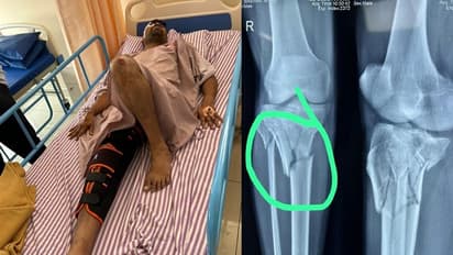 ಬಿಬಿಎಂಪಿ ನಿರ್ಲಕ್ಷ್ಯಕ್ಕೆ ವ್ಯಕ್ತಿಯ ಕಾಲು ಮುರಿತ, ತಲೆಗೆ ಗಂಭೀರ ಗಾಯ, ನೆರವಿಗೆ ಕುಟುಂಬಸ್ಥರ ಮನವಿ!