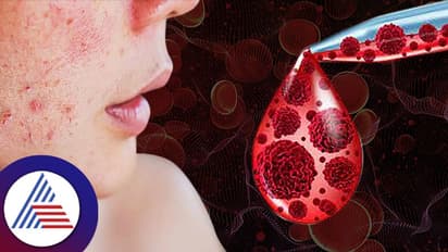 ಡೇಂಜರಸ್ ಬ್ಲಡ್ ಕ್ಯಾನ್ಸರ್ನಲ್ಲಿದೆ ಹಲವು ವಿಧ, ರೋಗಲಕ್ಷಣಗಳ ಬಗ್ಗೆ ಗೊತ್ತಿರ್ಲಿ