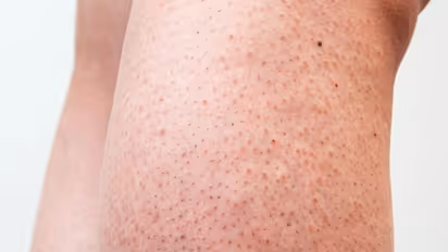 ഇങ്ങനെ ചെറിയ പുള്ളികള് തൊലിയില് ഉണ്ടോ? മാറാൻ ചെയ്യേണ്ടത്...