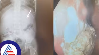 40 ಚೂಯಿಂಗ್ ಗಮ್ ನುಂಗಿದ ಐದು ವರ್ಷದ ಬಾಲಕ, ಸರ್ಜರಿ ಮಾಡಿದ ವೈದ್ಯರೇ ಬೆಚ್ಚಿಬಿದ್ರು!