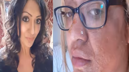 ടിക്ടോക്കിൽ വൈറലായ പാചകക്കുറിപ്പ് പരീക്ഷിച്ചു, മുട്ട പൊട്ടിത്തെറിച്ച് യുവതിക്ക് പൊള്ളൽ