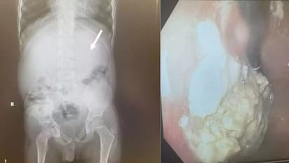 പതിവായി ച്യൂയിങ് ഗം വിഴുങ്ങി; ഒടുവില്‍ അഞ്ച് വയസുകാരന് സംഭവിച്ചത്...