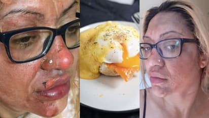 പാചകത്തിനിടെ മുട്ട പൊട്ടിത്തെറിച്ച് യുവതിക്ക് പൊള്ളലേറ്റു