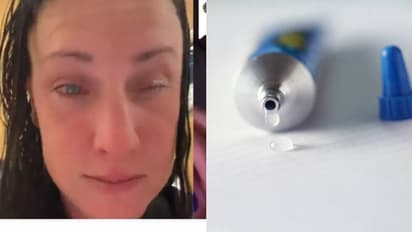 കണ്ണിലിറ്റിക്കുന്ന മരുന്നാണെന്ന് കരുതി സൂപ്പര്ഗ്ലൂ ഒഴിച്ചു; യുവതിക്ക് സംഭവിച്ചത്...