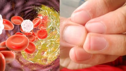 Health Tips: ചീത്ത കൊളസ്ട്രോളിന്റെ ഈ ലക്ഷണങ്ങള് അറിയാതെ പോകരുത്...