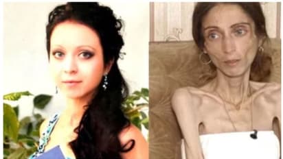 'ചീര്ത്ത കവിളെ'ന്ന് പരിഹാസം; 22 കിലോ കുറച്ച യുവതി ആശുപത്രിയില്, പിന്നാലെ ഭര്ത്താവും ഉപേക്ഷിച്ചു!