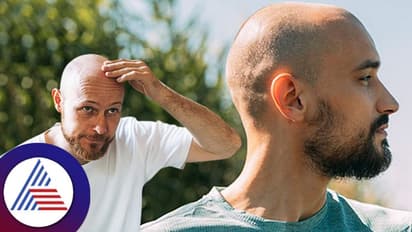 Bald Hair Style ಮಾಡಿದ್ರೆ ಕೂದಲು ದಟ್ಟವಾಗುತ್ತಾ? ಏನಿದ್ರ ಲಾಭ?