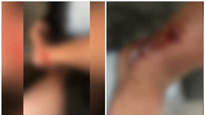 കുളിക്കാനിറങ്ങിയ 2 വിദ്യാർത്ഥികൾക്ക് നീർനായയുടെ കടിയേറ്റു; ആശുപത്രിയിൽ  പ്രവേശിപ്പിച്ചു