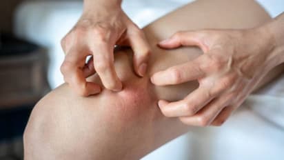 തൊലിയില്‍ കാണുന്ന പാടുകള്‍; ഈ രോഗമാണോയെന്ന് നിര്‍ബന്ധമായും പരിശോധിക്കുക...