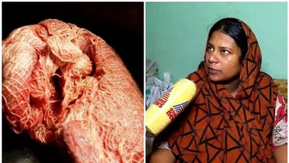 പ്രസവ ശസ്ത്രക്രിയക്കിടെ വയറ്റില് പഞ്ഞി മറന്നുവച്ചെന്ന് പരാതി; പാലക്കാട് പാലന ആശുപത്രിക്കെതിരെ കേസെടുത്തു