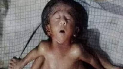 നാല് കൈകളും നാല് കാലുകളുമായി കുഞ്ഞ്, കാണാൻ നഴ്സിങ് ഹോമിന് മുന്നിൽ ജനക്കൂട്ടം