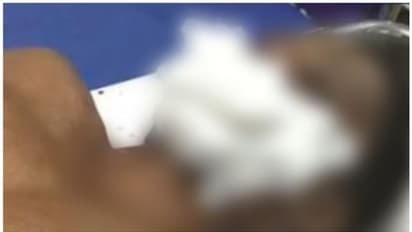 നായപ്പേടിയിൽ നാട്; കാസർകോട് തെരുവുനായ ആക്രമണം; മധ്യവയസ്കന്റെ കീഴ്ചുണ്ട് കടിച്ചെടുത്തു