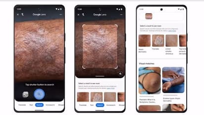 ചര്മ്മത്തില് വല്ല പ്രശ്നവും ഉണ്ടോ?; ഗൂഗിള് ലെന്സ് ഉപയോഗിച്ച് കണ്ടെത്താം.!