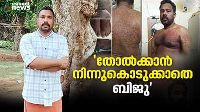 ആദ്യം ചെറിയ കുത്തുകള്‍- പിന്നീട് അവസ്ഥയാകെ മാറി; ജീവിതം അട്ടിമറിച്ച അനുഭവത്തെ കുറിച്ച്...