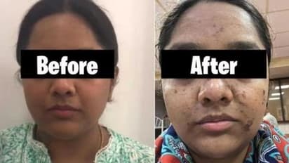 17,000 രൂപയുടെ ഫേഷ്യല് ചെയ്ത് മുഖം പൊള്ളി; സലൂണിനെതിരെ കേസ്