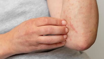 படர்தாமரை வந்தால் வீட்டிலேயே குணப்படுத்துவது எப்படி? ஒரே 1 துண்டு மஞ்சள் போதும்!! 