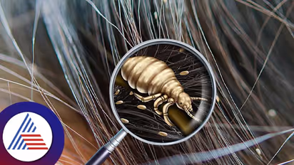 Hair Care :  ಕೊಳಕಿನ ಕಾರಣ ಬಿಟ್ಟು, ತಲೇಲಿ ಹೇನು ಆಗೋಕೆ ಬೇರೆ ಕಾರಣವಿದ್ಯಾ?